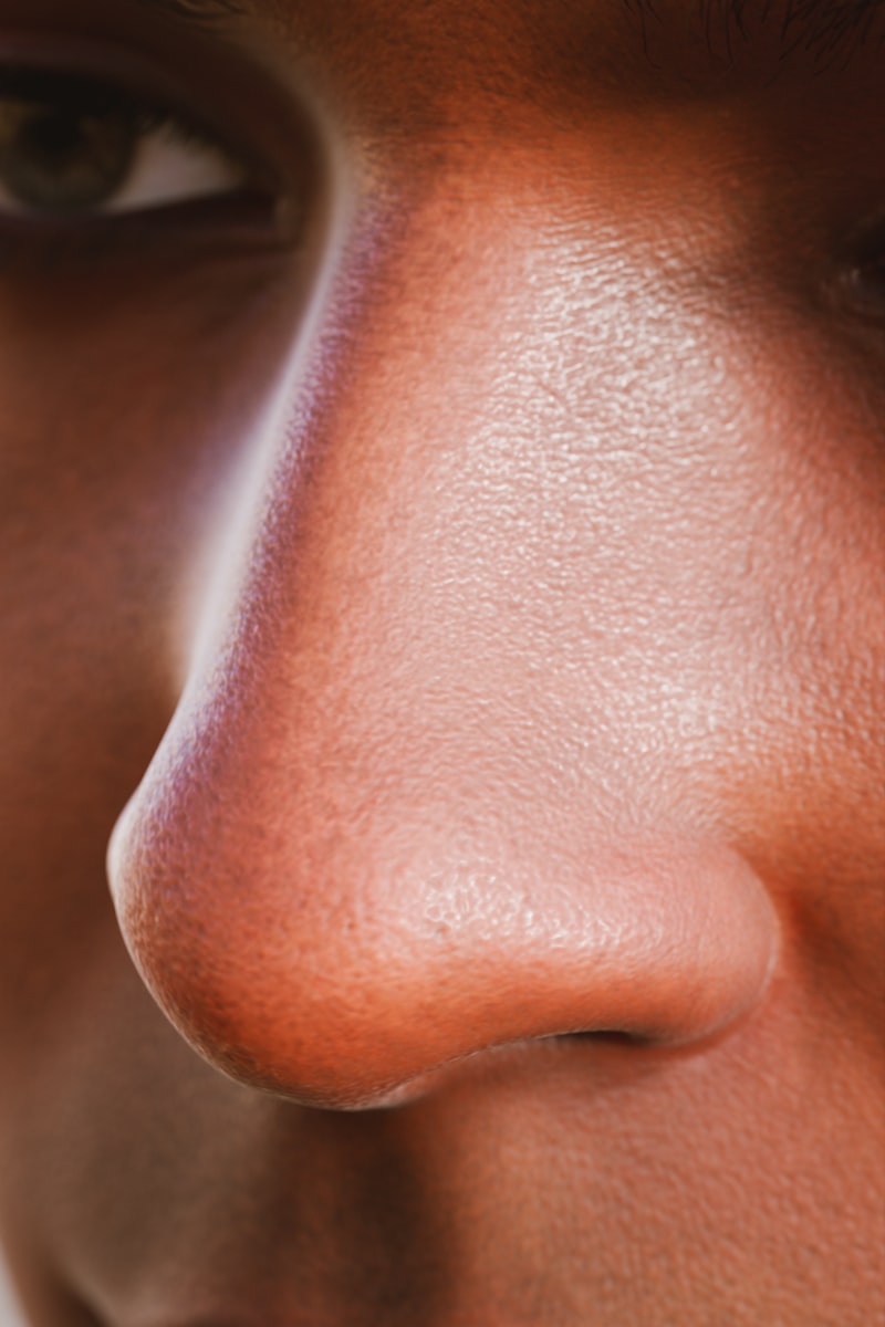 Post-inflammatory hyperpigmentation